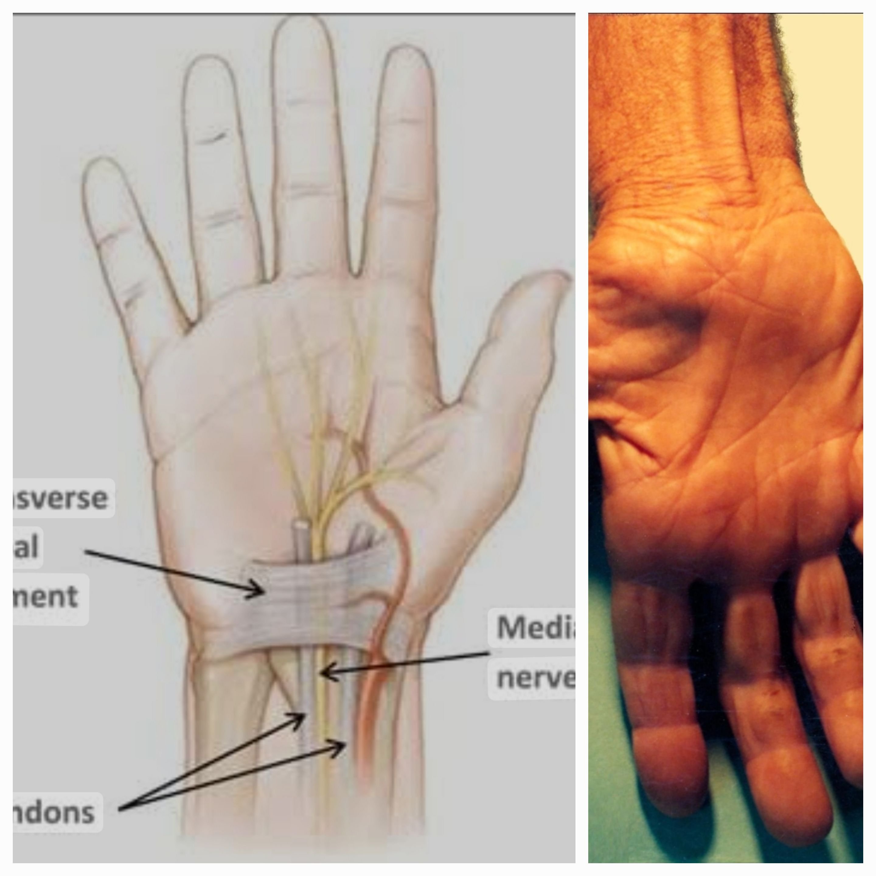 Navigating the Depths of Carpal Tunnel Syndrome: Understanding, Coping, and Overcoming